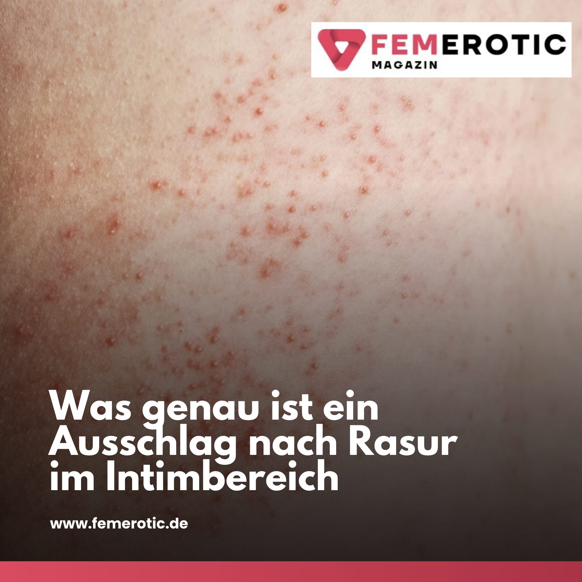 Was genau ist ein Ausschlag nach Rasur im Intimbereich Was genau ist ein Ausschlag nach Rasur im Intimbereich